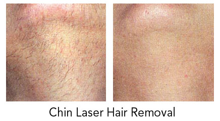 chin-laser-hair-removal-winnipeg