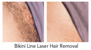winnipeg-laser-hair-removal-brazilian