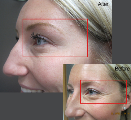 botox winnipeg before and after crows feet