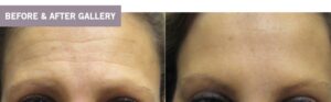 Botox with Dr. Minuk's Laser Centre and SkinClinic