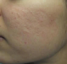 CO2 fractional Acne after
