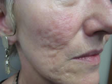 CO2 fractional Acne before