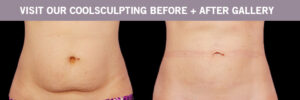 CoolSculpting BEFORE AND AFTERS Winnipeg