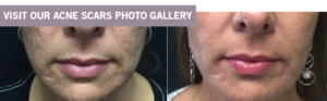 Acne Scars Treatment in Winnipeg by Dr. Minuk`s SkinClinic and Laser Centre