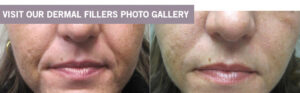 Dermal Fillers at Dr. Minuk's SkinClinic and Laser Centre