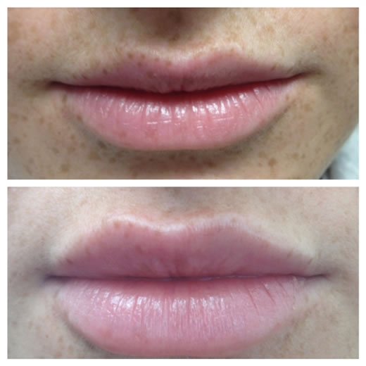 Lip Enhancements - before-after1