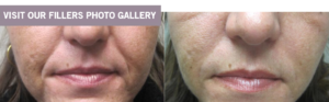 Fillers in Winnipeg, Manitoba Before and After Gallery