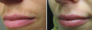 Clear+Brilliant Permea Laser* (* Before and After results may vary )