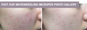 Microneedling MicroPen at Dr. Minuk SkinClinic & Laser Centre, Winnipeg