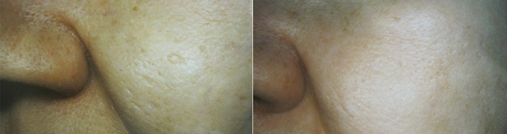 Fractional CO2 Laser, Acne Scar Removal at Dr. Minuk`s SkinClinic and Laser Centre