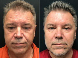 Fillers for Men in Winnipeg, Dr Minuk's SkinClinic & Laser Centre Before and Afters