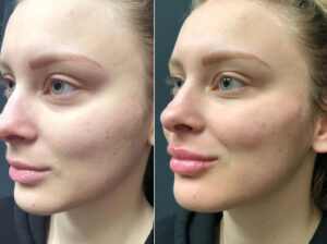 Top Model Botox Filler Makeover Dr Minuk Winnipeg