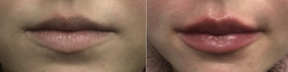 Before and After Lip Enhancement Winnipeg