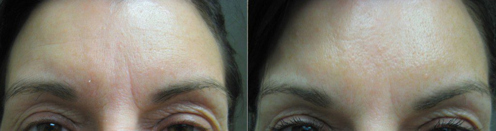Botox for forehead lines in Winnipeg at Dr. Minuk's SkinClinic & Laser Centre