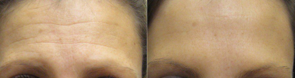 Botox for forehead lines in Winnipeg at Dr. Minuk's SkinClinic & Laser Centre