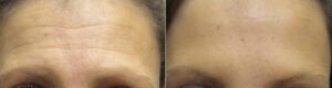 Botox for forehead lines in Winnipeg at Dr. Minuk's Laser Centre and SkinClinic