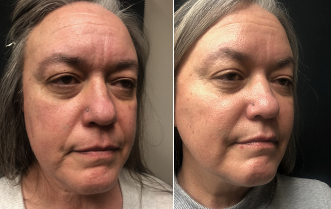 Botox Filler Before and After Winnipeg
