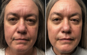 Botox Filler Before and After Winnipeg
