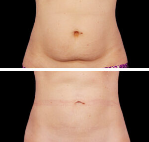Coolsculpting before and after in Winnipeg, Manitoba