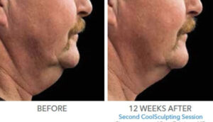 CoolSculpting Double Chin Before and After