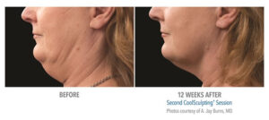 CoolSculpting Double Chin Before and After