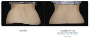 CoolSculpting Back Before and After