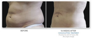 CoolSculpting Stomach Before and After