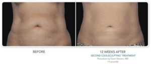 CoolSculpting Stomach Before and After