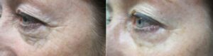 Botox for Crow's Feet in Winnipeg at Dr. Minuk's Laser Centre and SkinClinic