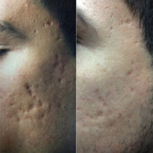 Fraxel Laser, Acne Scar Removal at Dr. Minuk`s SkinClinic and Laser Centre