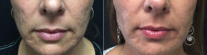 Fractional CO2 Laser, Acne Scar Removal at Dr. Minuk`s SkinClinic and Laser Centre