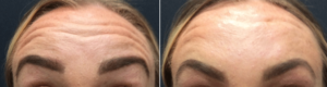 Dysport Forehead Treatment Winnipeg