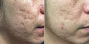 Infini RF, Acne Scar Removal at Dr. Minuk`s SkinClinic and Laser Centre