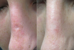 Chicken Pox Scar Removal at Dr. Minuk`s SkinClinic and Laser Centre