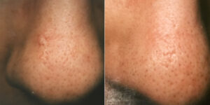 Nose Scar Removal at Dr. Minuk`s SkinClinic and Laser Centre