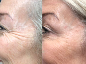 BotoxCosmetic & Filler to crows feet and upper cheeks