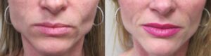 Botox for massester muscle in Winnipeg at Dr. Minuk's Laser Centre and SkinClinic