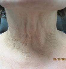 fraxel neck before