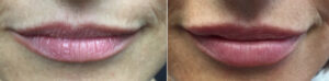 Lip Enhancements by Dr. Minuk
