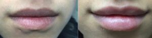 Lip Fillers at Dr. Minuk's SkinClinic and Laser Centre