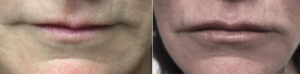 Lip Fillers at Dr. Minuk's SkinClinic and Laser Centre