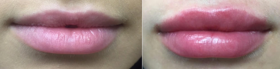 Lip Enhancements by Dr. Minuk in Winnipeg