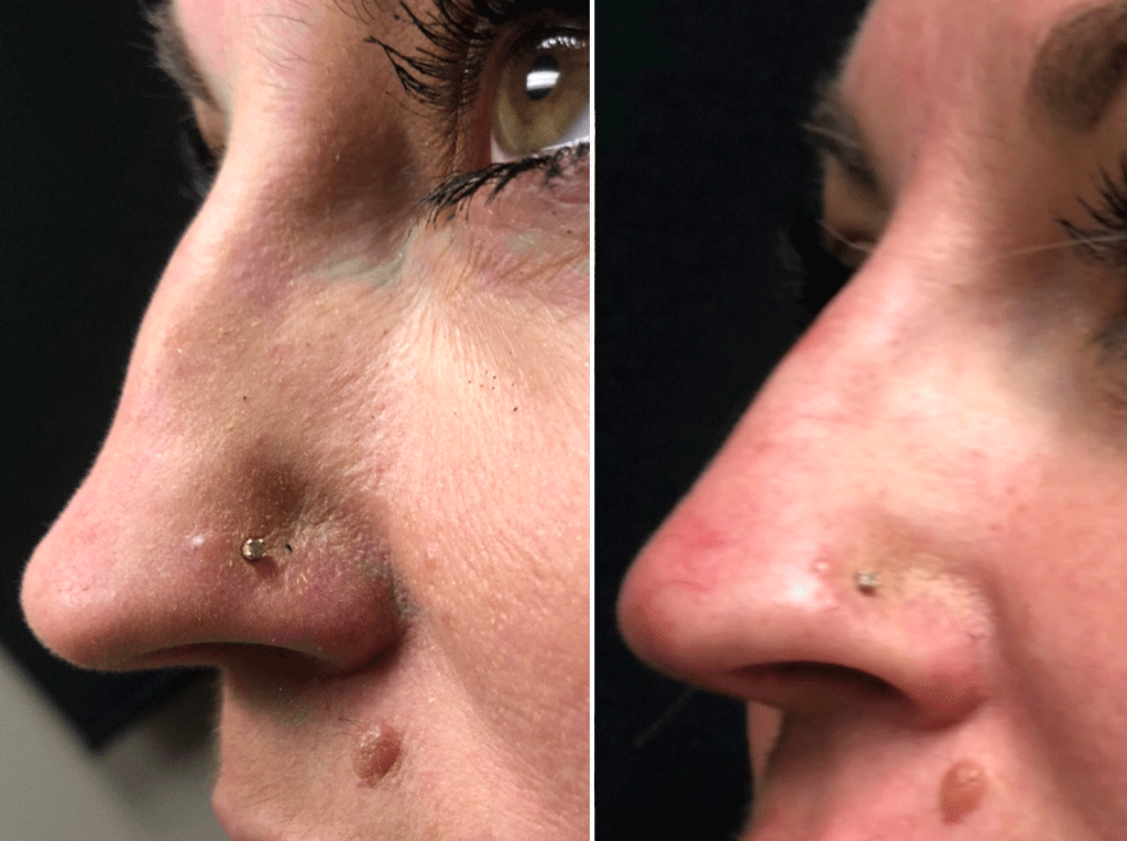 Non-surgical Rhinoplasty Before And After Winnipeg 