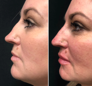 Non-surgical Rhinoplasty Before And After Winnipeg