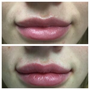 Dr. Minuk SkinClinic & Laser Centre Lip Enhancement and Injections
