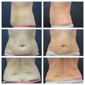 Coolsculpting before and after in Winnipeg, Manitoba