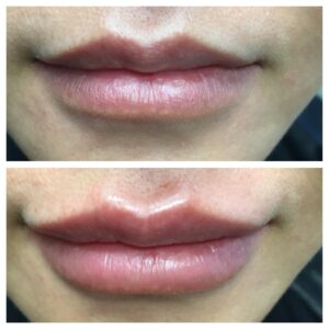 Dr. Minuk SkinClinic & Laser Centre Lip Enhancement and Injections