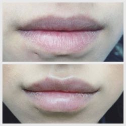 Dr. Minuk SkinClinic & Laser Centre Lip Treatments