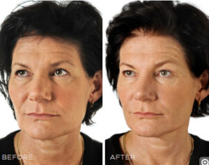 Restylane Skin Boosters in Winnipeg, Manitoba by Dr. Minuk