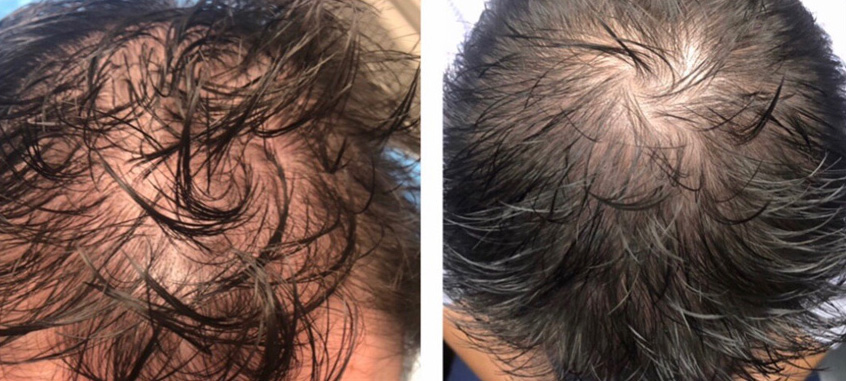 Hair Loss Treatment Winnipeg
